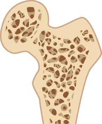 Bild: Knochenquerschnitt Osteoporose